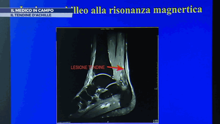 Il medico in campo: la rottura del tendine d'Achille