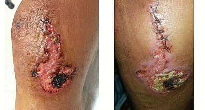 il ginocchio di Contador - foto Twitter il ginocchio di Contador - foto Twitter